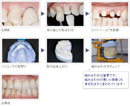 審美セラミック治療の流れ